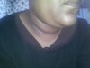 After neck lipo pic