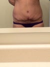 36 yr old, had a tummy tuck done 6.5 weeks ago. Unhappy with the results