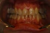 Invisalign, braces or both?