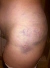 Bruising 2 days post op