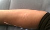self-inflicted burn scars on my arms