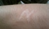 scar is flush with the surface of the skin