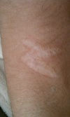 arm burn scarring