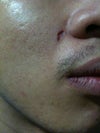 Sunken Scar on Cheek
