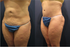 Tummy Tuck Revision Before and After Photos
