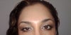 Only the top 1/3 of the forehead (closest to hairline)  was injected and maybe 5 units between the brows.