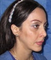 showing asymetry and hollowness in right side more