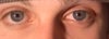 right eye appears to be drooping and im only 17