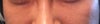 tear troughs smiling