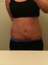 8 weeks post op