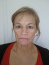 Mini lift with fat transfer and myectomy lateral orbicularis under local?