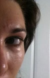 Bag under left eye
