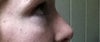 Profile photo of right eye swelling