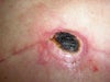 Left Areola