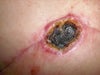 Right Areola