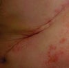 Scar Attached To Muscle/Tissue