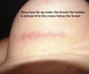 Incision under breast instead of in the crease!