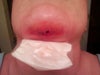 View closer to wound.  There is minor tenderness in surrounding area, but no fever or redness.