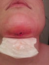 Close up. Betadine treatment surrounding 0.75 x 0.5 cm wound.