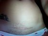 C section scar