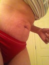 15 days post op, skin loosening