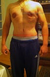 6 WEEKS POST OP