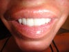 Very noticeable when smiling.