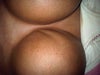 after the third surgery... rippling down the right breast