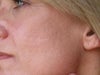 have been using tretinoin daily 
for eight months, but only once a week for the past two weeks.