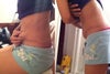 after tummy tuck