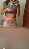 Before my tummy tuck
