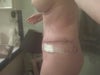 8 days post op side