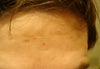 Forehead scars. Large one on left side of photo. Not shown is large one on cheek.