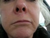 lip lift scar