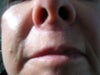 sub nasal scar