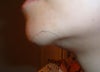 6 months post op
