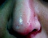 the two holes on the tip of my nose ( left and right)
