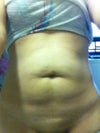 I'm 29, non smoker, I dont have any stretch marks on my stomach