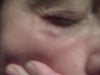 Sculptra nodules/granulomas #1
