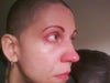 Right eye for comparison - no surgery