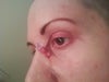 Post-op left eye w/ pulling skin