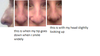 small hump and drooping tip when smiling