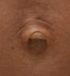 My navel is now inside out.