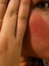 I believed it was hyperpigmentation for awhile, but after bleaching treatments with no results, I began to believe otherwise. I'm aware that everyone's face is a different color than the rest of their body, but this is a little extreme. Please help.