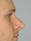 Right Side View Primary Rhinoplasty