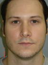 Front View Primary Rhinoplasty