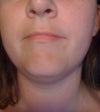 I cannot tell b/c of square jawline if I should plan to have jowls so that they don't look awkward/out of place after under chin is gone, but does jowl work age well?