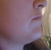 Profile.  Would I get enough skin tightening to have results?  I am not ever getting a chin lift.