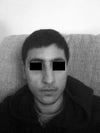 Frontal view - clear deformity of nose. Nose has practically shifted to one side of my face