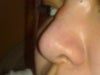 side view of the bump